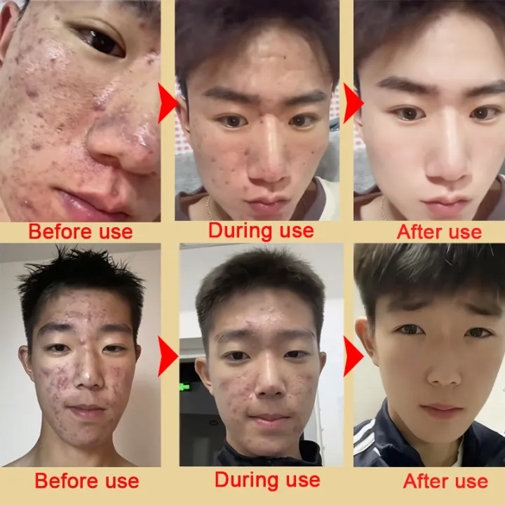 Pencuci Muka, oil control and acne treatment, deep cleansing, removes oil and blackheads, anti-mite, refreshing and gentle, moisturizing, suitable for all skin types, brightens skin tone, 150ml